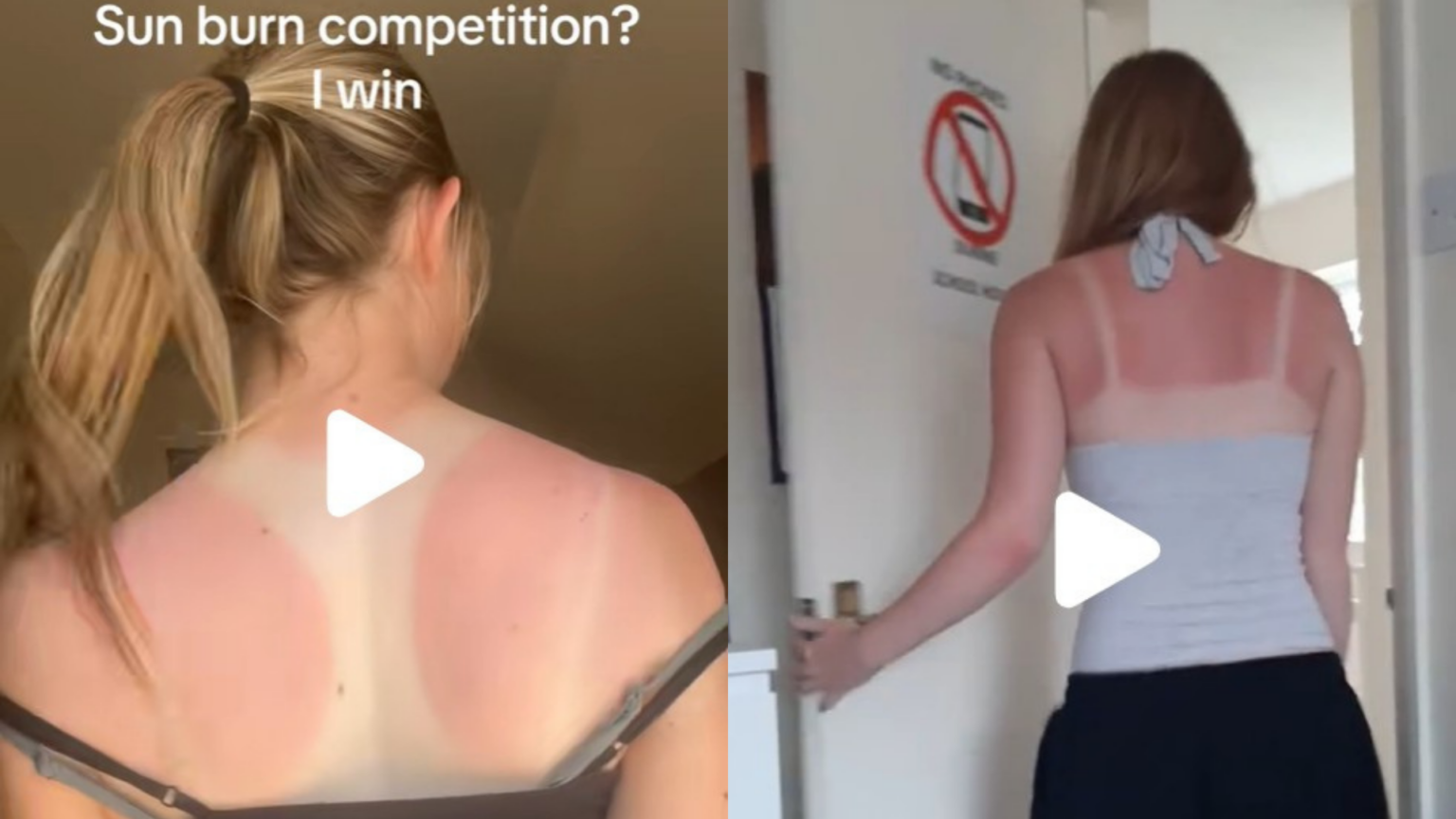 Si chiama ‘Sunburn Challenge’ ed è la follia dell’estate: ragazzi in gara a chi si ustiona di più