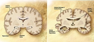 Poggibonsi, terza giornata sull'Alzheimer