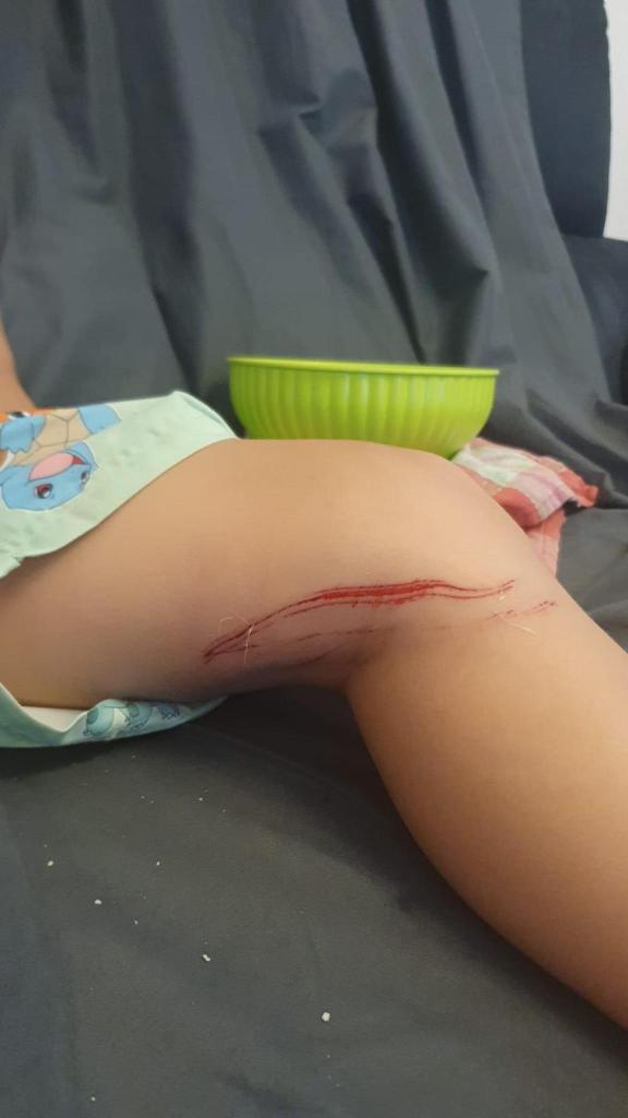 Si rompe una grata in piscina a Poggibonsi, bimbo si ferisce alla gamba