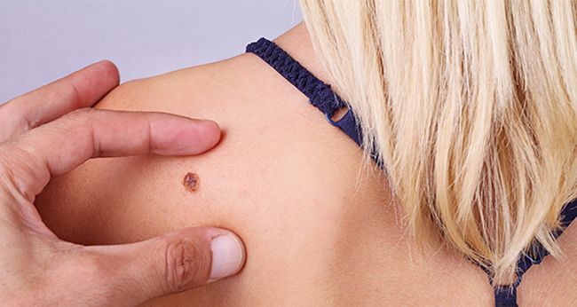 Melanoma, un nemico invisibile; la rivelazione del chirurgo: &ldquo;Non &egrave; dove pensiamo&rdquo;